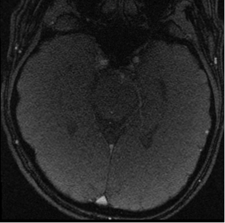 Cerebrospinal fluid flow MRI | CSF flow MRI protocol and planning