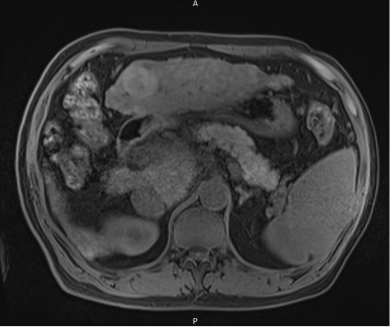 Hepatocellular carcinoma (HCC) MRI