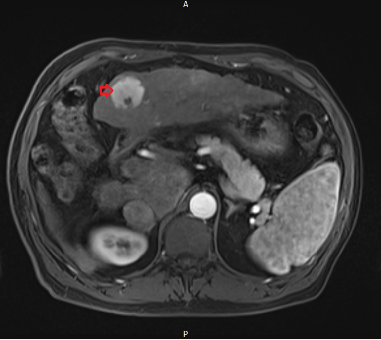 Hepatocellular carcinoma (HCC) MRI