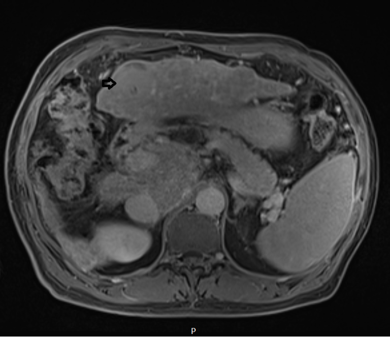 Hepatocellular carcinoma (HCC) MRI