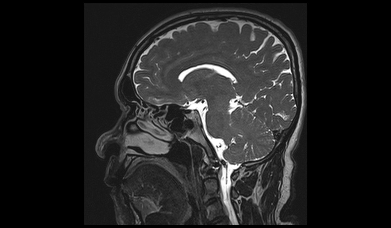 T2 SPACE 3D Mid-brain Sagittal 0.5 mm 2 T2 SPACE 3D Mid-brain Sagittal 0.5 mm 2