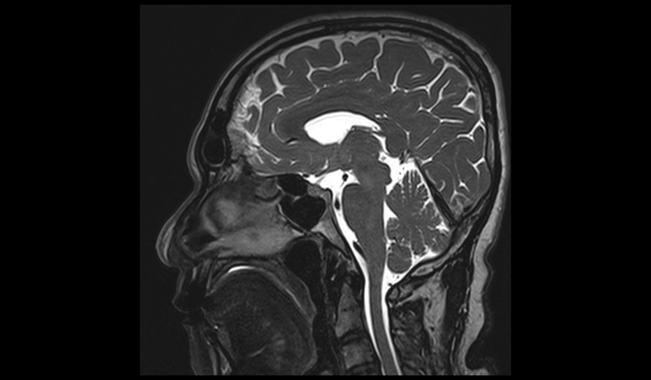 Cerebrospinal fluid flow MRI | CSF flow MRI protocol and planning