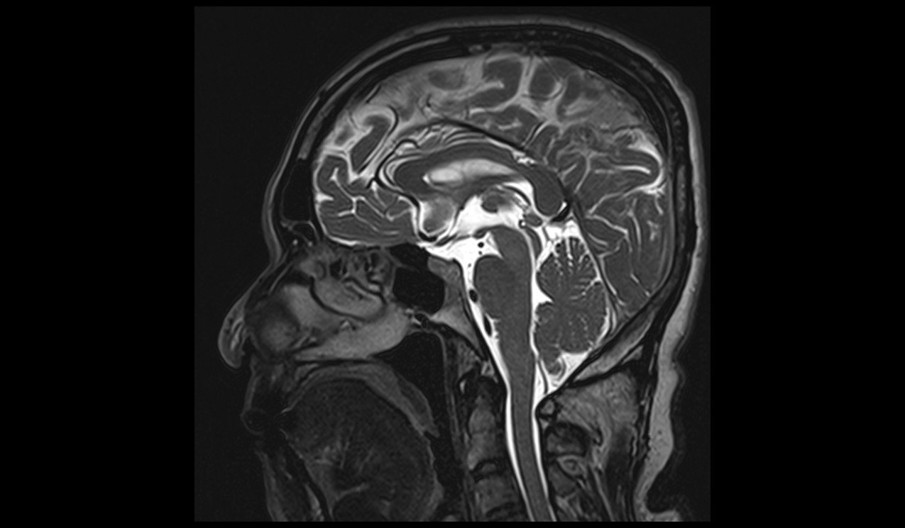 T2 SPACE 3D Mid-brain Sagittal 0.5 mm 4 T2 SPACE 3D Mid-brain Sagittal 0.5 mm 4