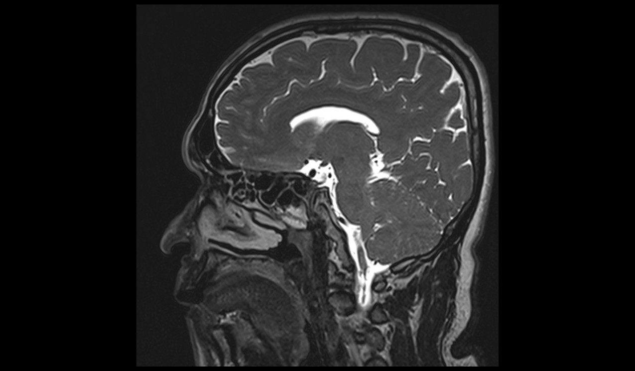 Cerebrospinal fluid flow MRI | CSF flow MRI protocol and planning