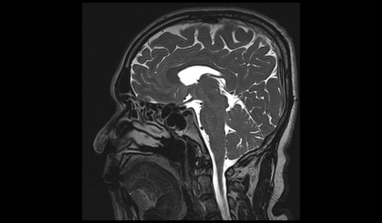 T2 SPACE 3D Mid-brain Sagittal 0.5 mm5 T2 SPACE 3D Mid-brain Sagittal 0.5 mm5