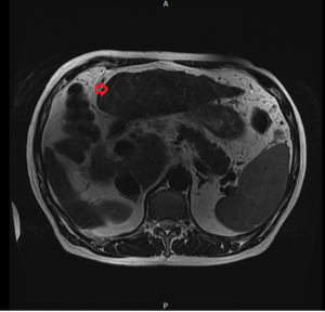 Hepatocellular carcinoma (HCC) MRI