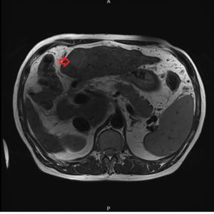 Hepatocellular carcinoma (HCC) MRI