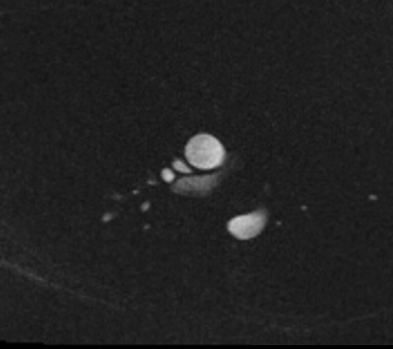 Phase contrast fow MRI | Phase contrast CSF and blood MRI physics and ...