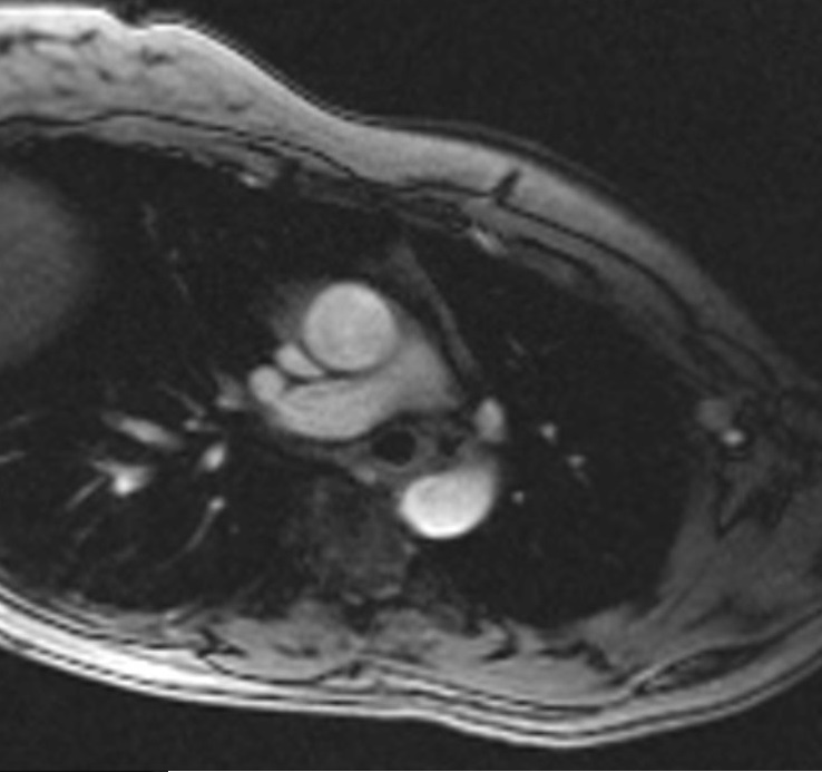 Phase contrast fow MRI | Phase contrast CSF and blood MRI physics and ...