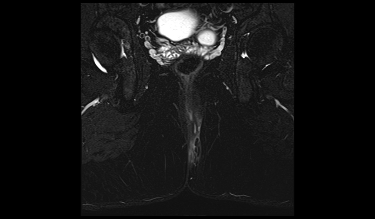 Perianal fistula MRI | Radiology article on Perianal fistula MRI