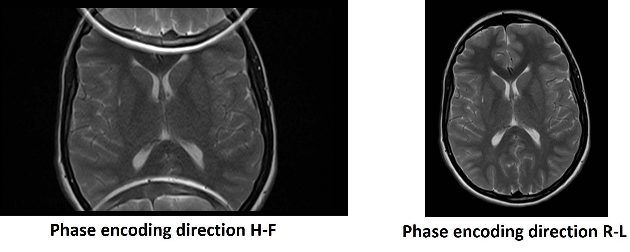 Phase encoding in MRI | MRI Phase encoding direction