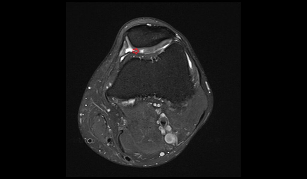 Chondromalacia MRI | Radiology Article on chondromalacia patellae