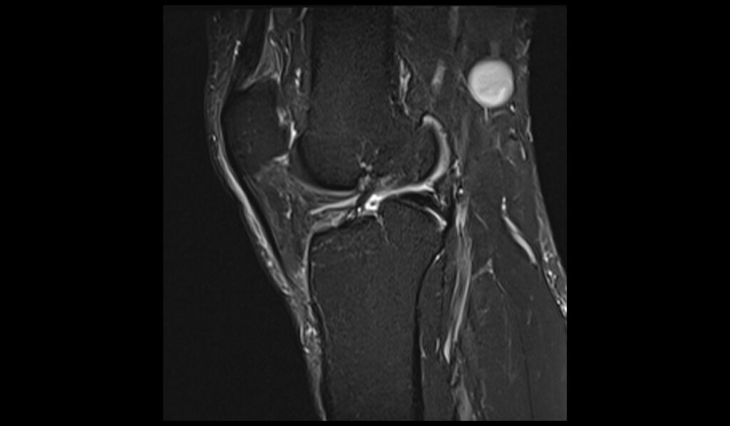 Chondromalacia MRI | Radiology Article on chondromalacia patellae