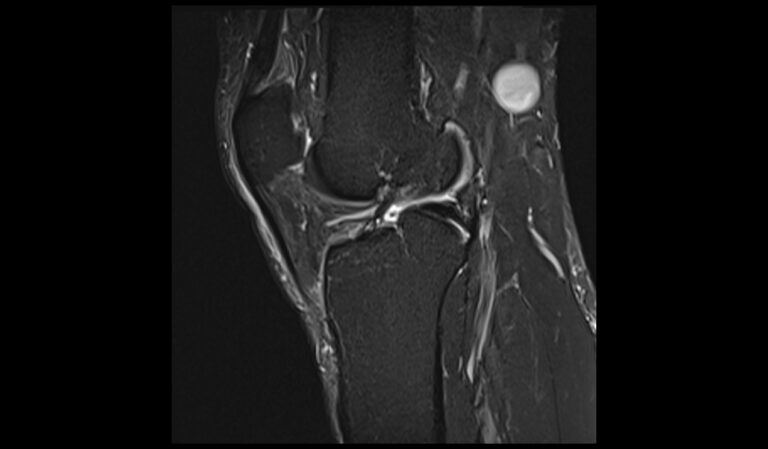 Chondromalacia MRI | Radiology Article on chondromalacia patellae