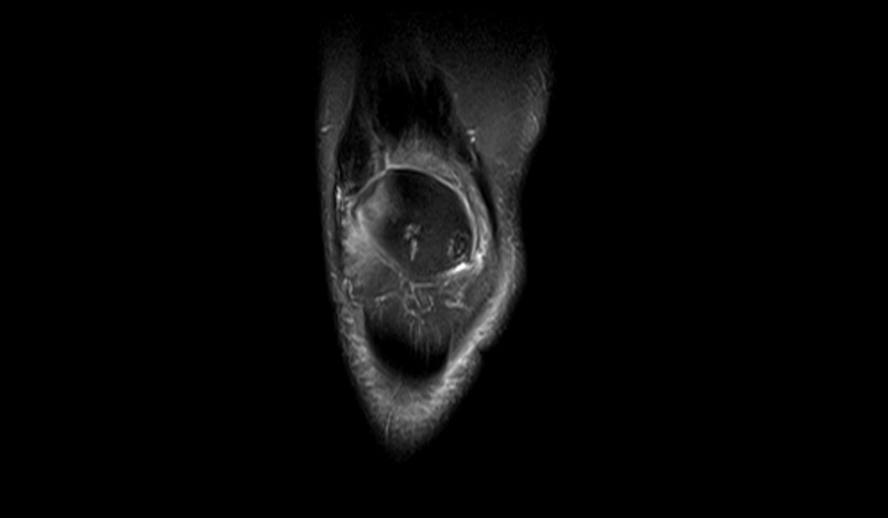 Chondromalacia MRI | Radiology Article on chondromalacia patellae