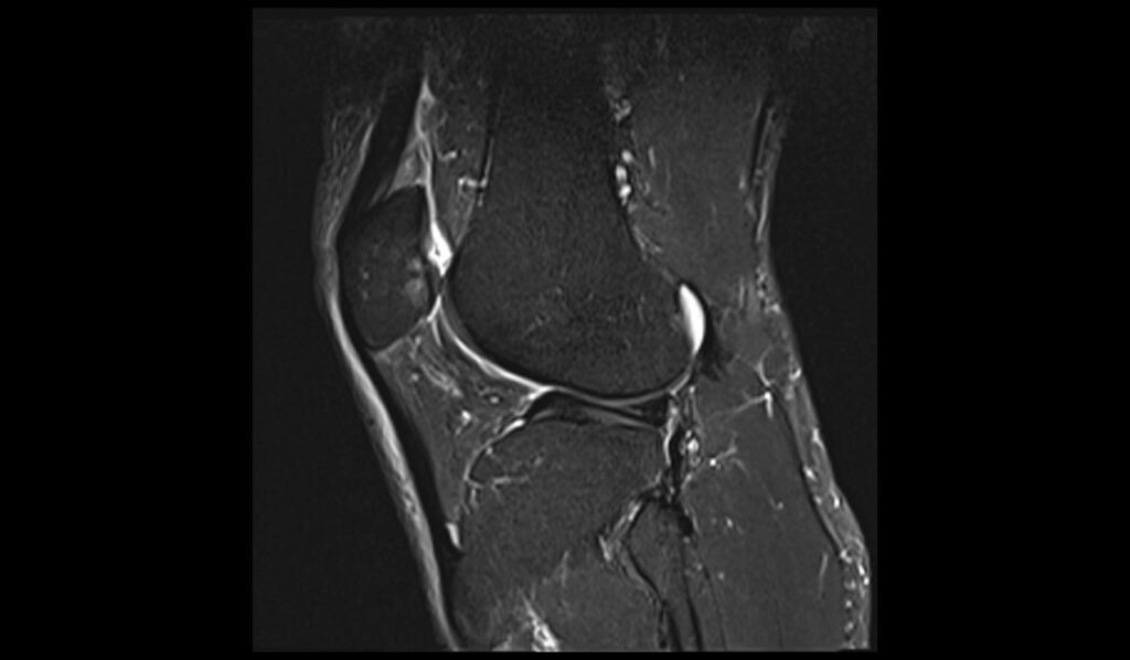 Chondromalacia grade 4 MRI STIR Sagittal image