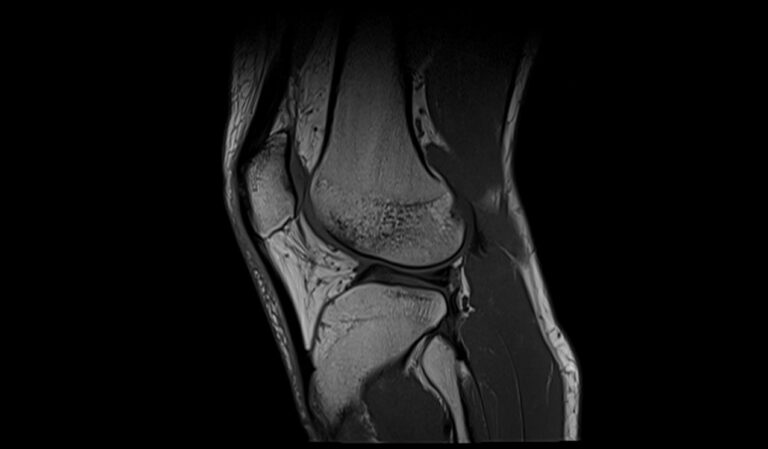 Chondromalacia MRI | Radiology Article on chondromalacia patellae