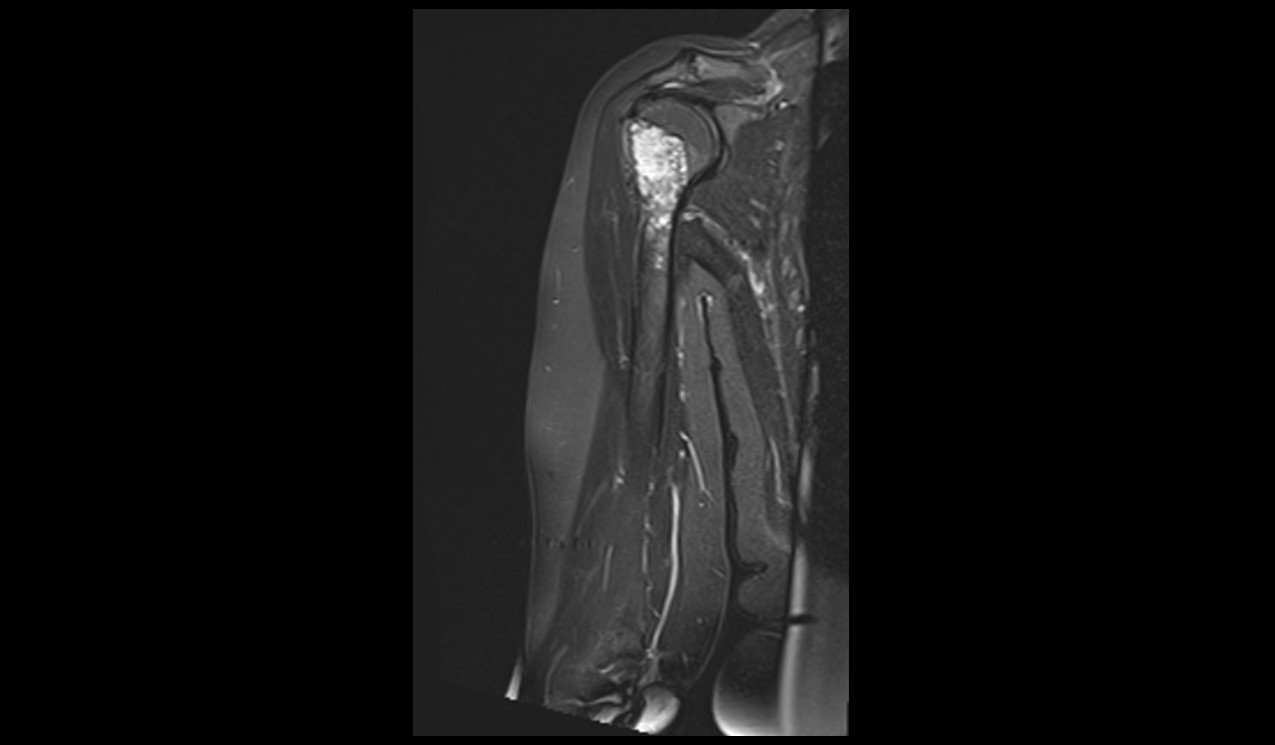 Enchondroma MRI | Radiology Article on Enchondroma MRI