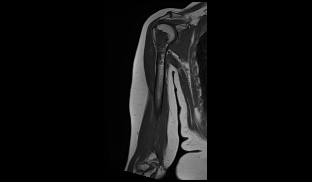 Enchondroma MRI | Radiology Article on Enchondroma MRI