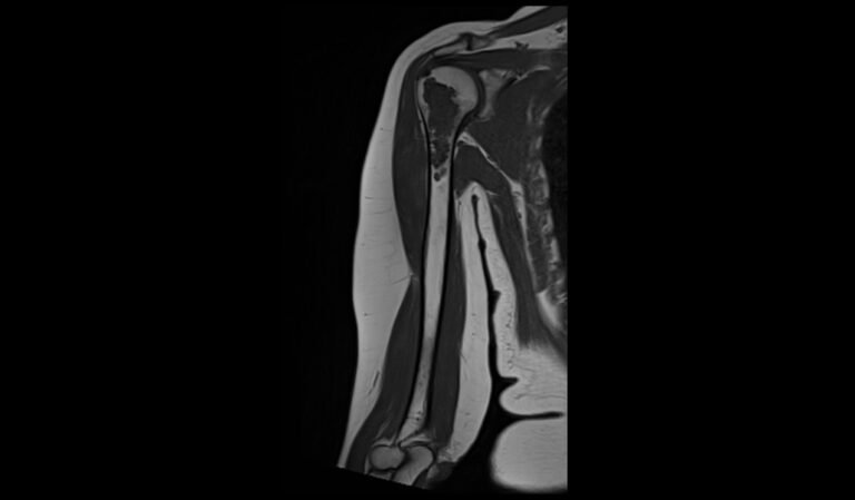 Enchondroma MRI | Radiology Article on Enchondroma MRI