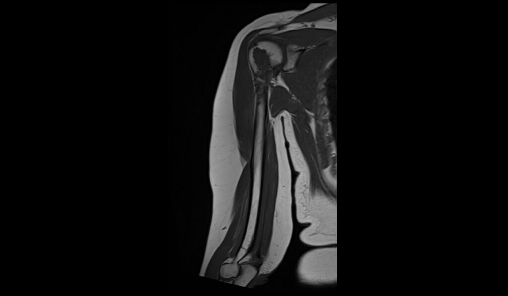 Enchondroma MRI | Radiology Article on Enchondroma MRI