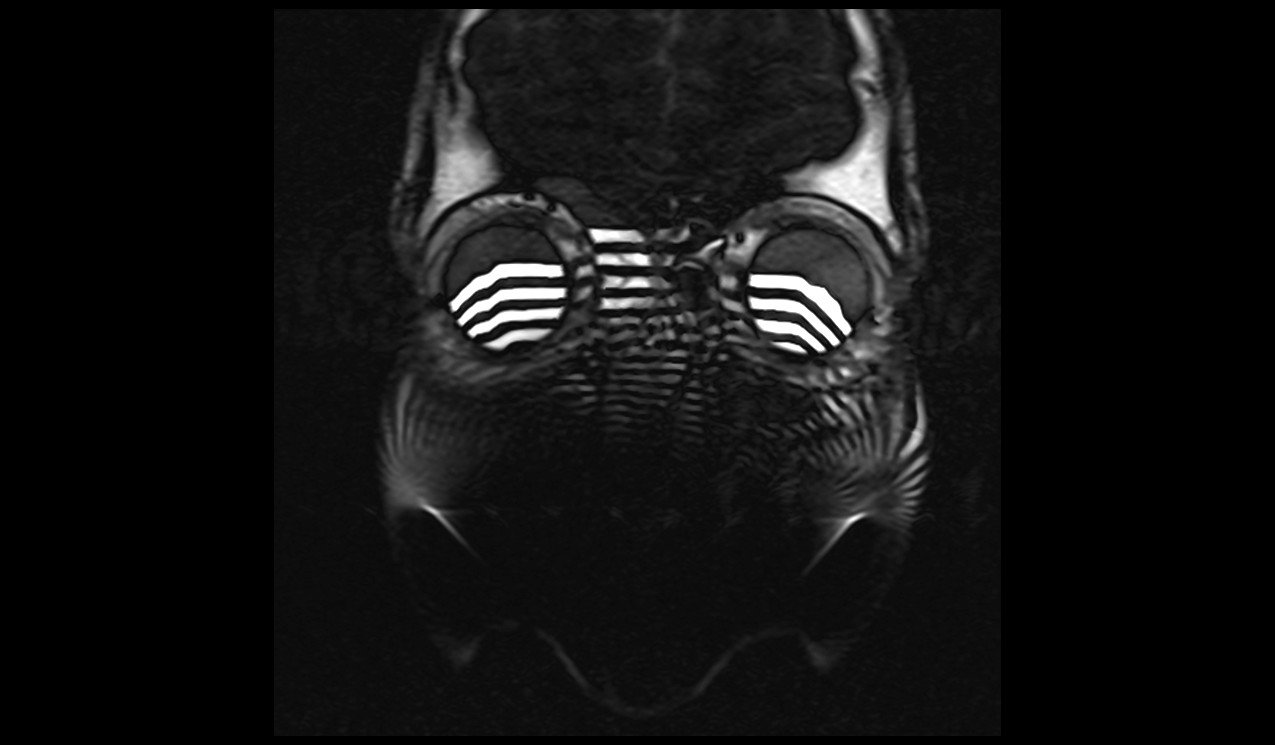 Field Inhomogeneity related Zebra Artifact Field Inhomogeneity related Zebra Artifact