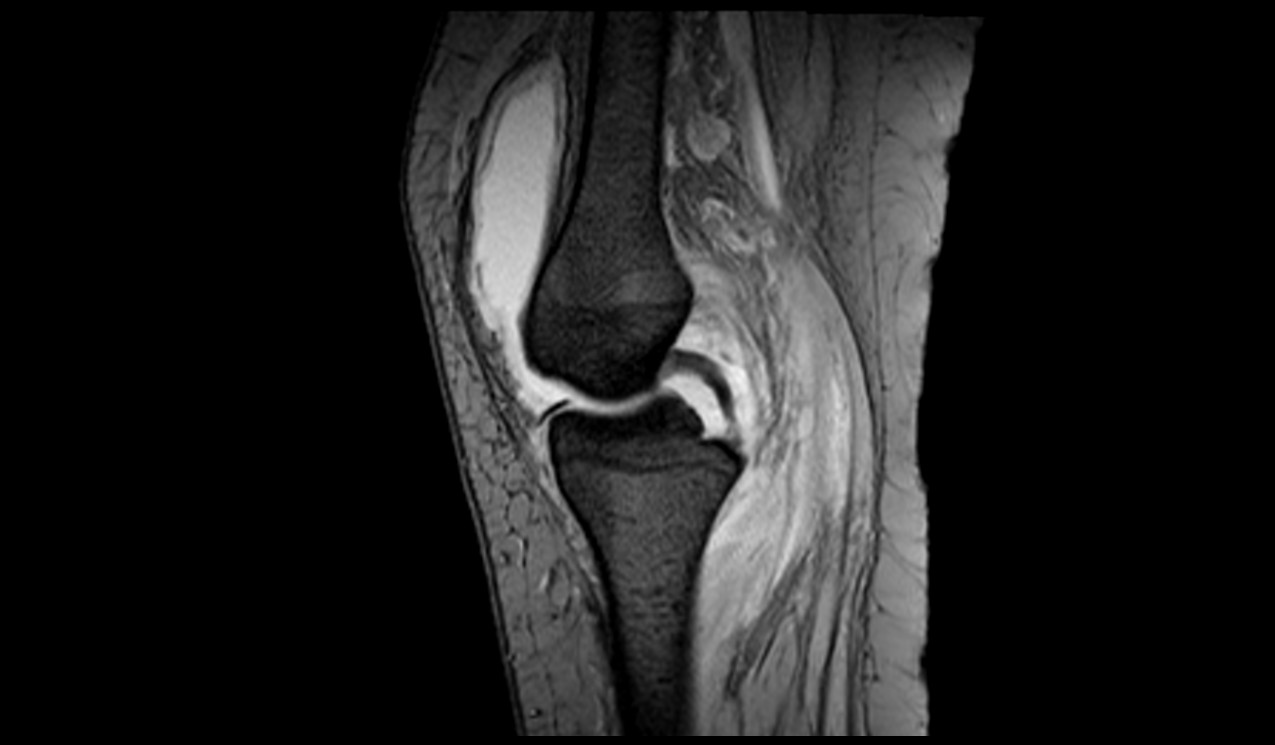 Knee Synovitis MRI| Radiology Article on Knee Synovitis