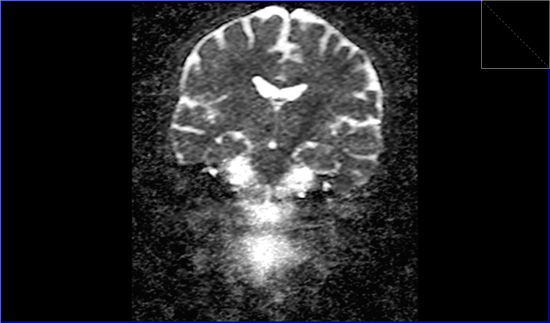 cholesteatoma MRI | Radiology article on cholesteatoma