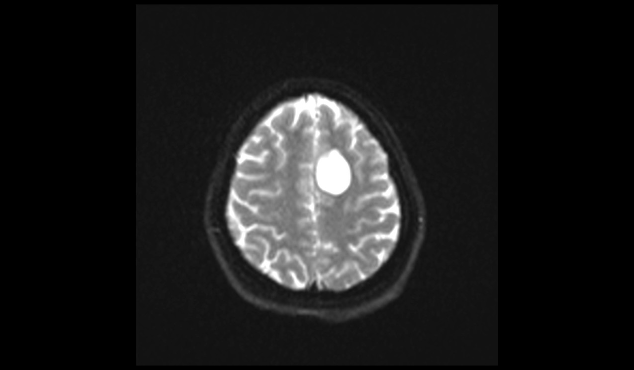 Neuroglial Cysts MRI | Radiology Article on Glioependymal Cysts