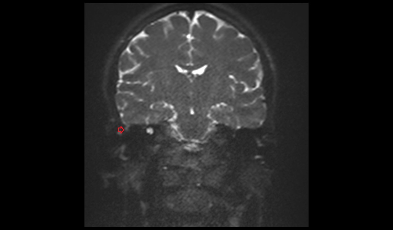 cholesteatoma MRI | Radiology article on cholesteatoma