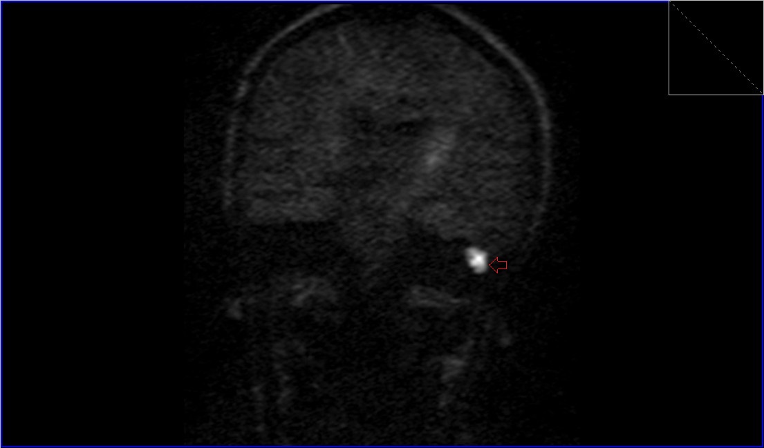 cholesteatoma MRI | Radiology article on cholesteatoma