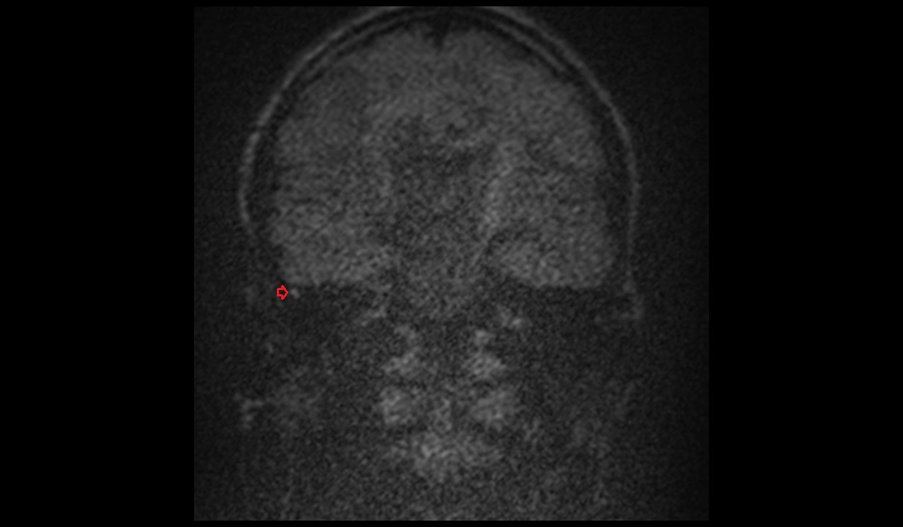 cholesteatoma MRI | Radiology article on cholesteatoma