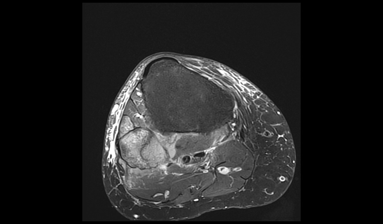 Knee Lymphoma MRI | Radiology Article on Knee Lymphoma