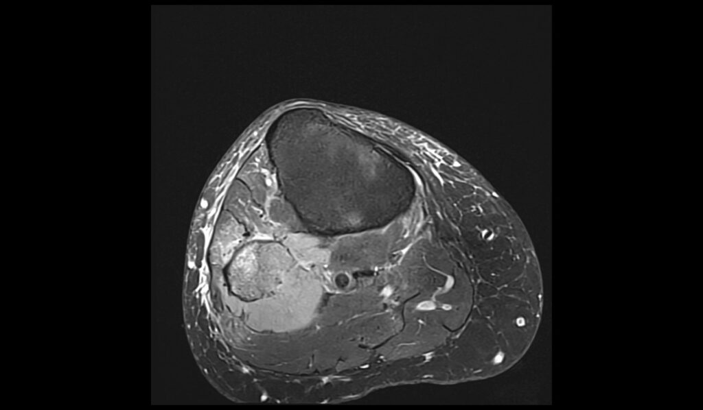 Knee Lymphoma MRI | Radiology Article on Knee Lymphoma