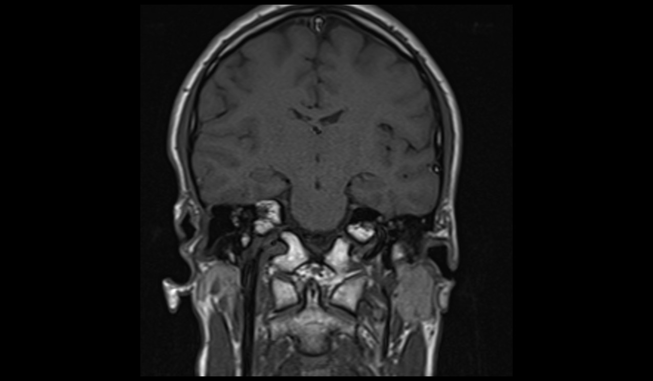 cholesteatoma MRI | Radiology article on cholesteatoma