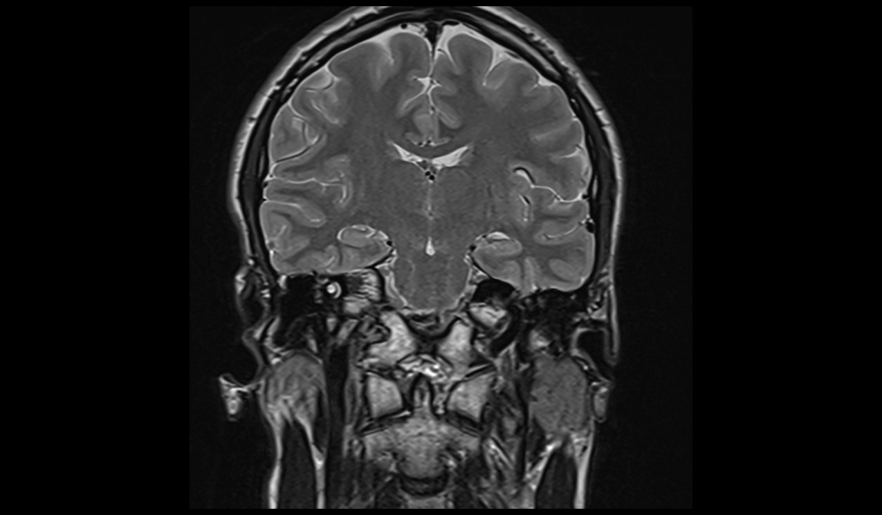 cholesteatoma MRI | Radiology article on cholesteatoma