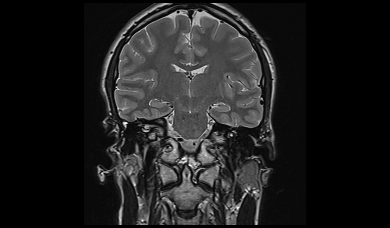 cholesteatoma MRI | Radiology article on cholesteatoma