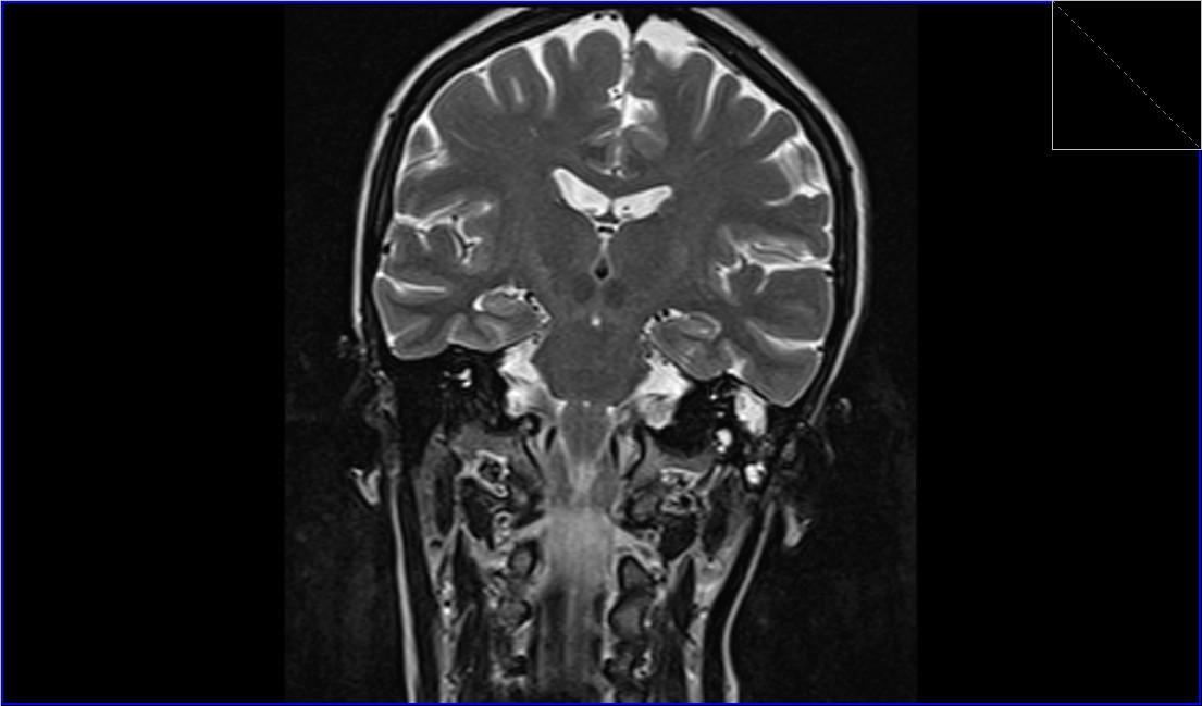 cholesteatoma MRI | Radiology article on cholesteatoma