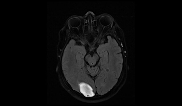 Late Subacute Hemorrhage MRI | Radiology Article on Late Subacute ...