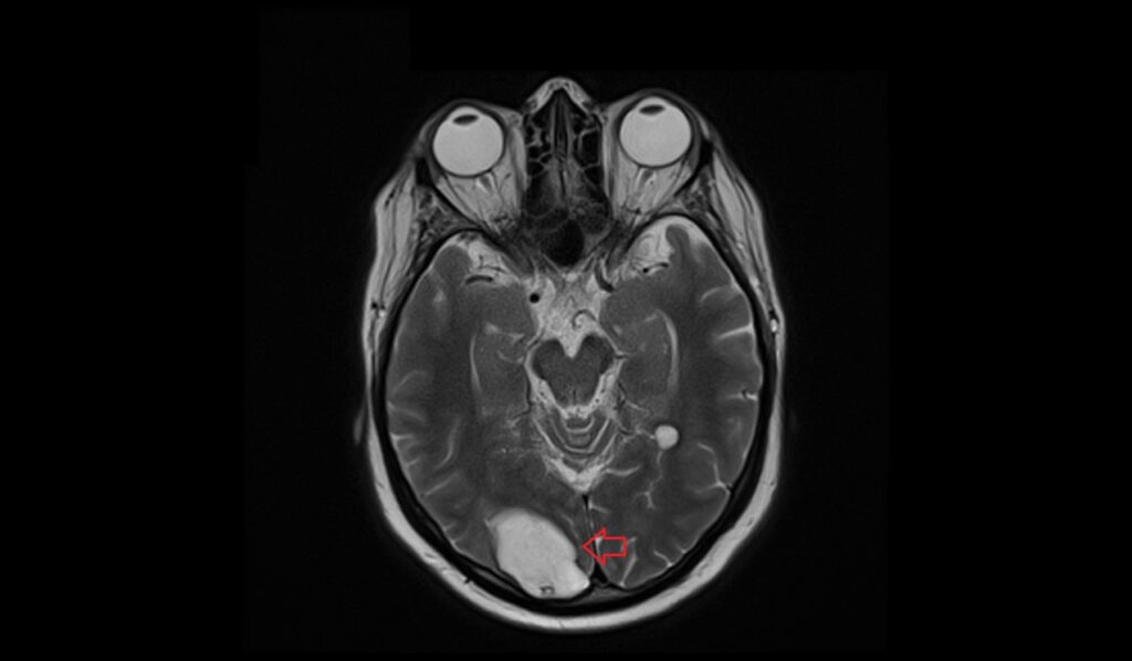 Late Subacute Hemorrhage MRI | Radiology Article on Late Subacute ...