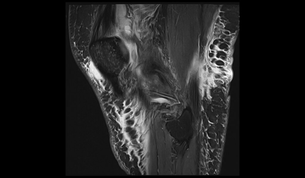 MRI patellar dislocation sagittal pd fat saturated image 1