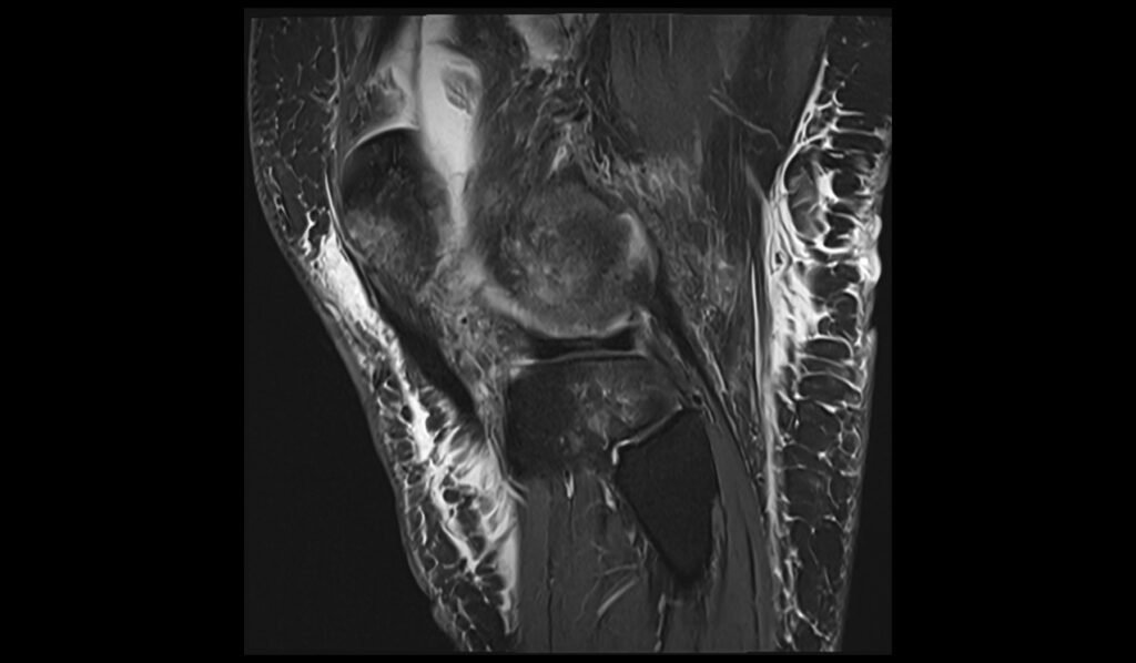 MRI patellar dislocation sagittal pd fat saturated image 2