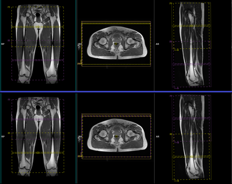 MRI Thigh Two-Station Automatic Composing Protocol and planning