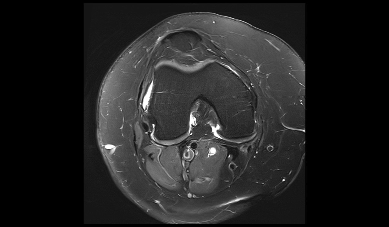 Anterior cruciate ligament tear MRI | Radiology Article on ACL tear
