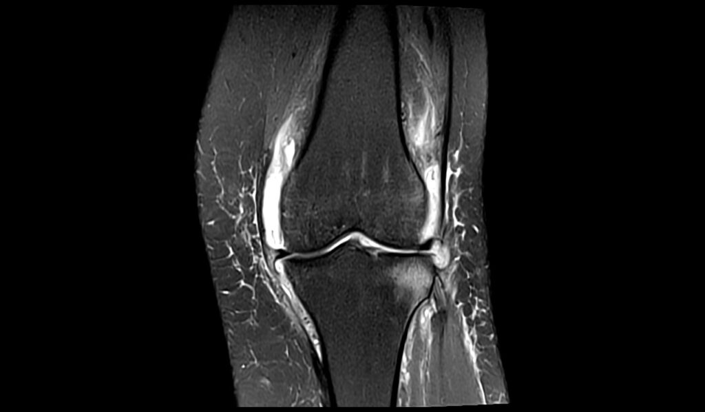 Knee Synovitis MRI| Radiology Article on Knee Synovitis