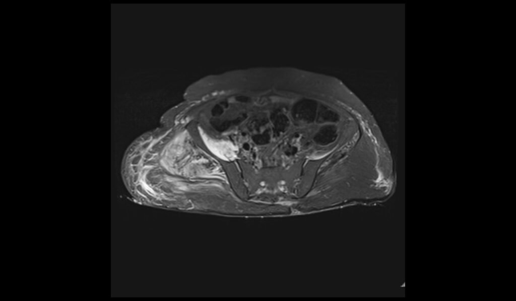 STIR axial image of pelvis shows pelvic osteomyelitis 1