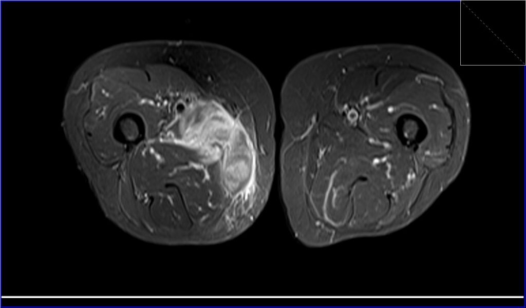 Infectious Myositis MRI | Radiology article on Infectious Myositis