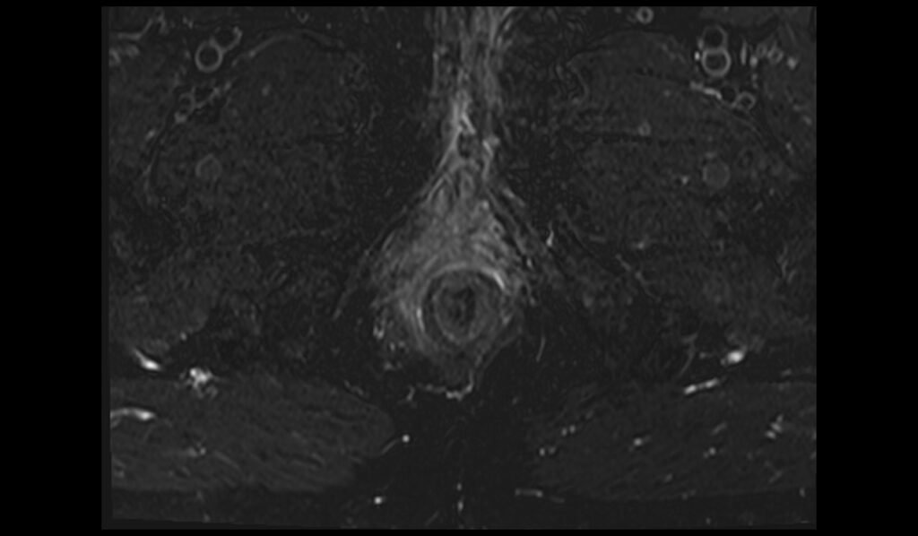 STIR axial oblique image of anal canal shows Perianal Fistula 2
