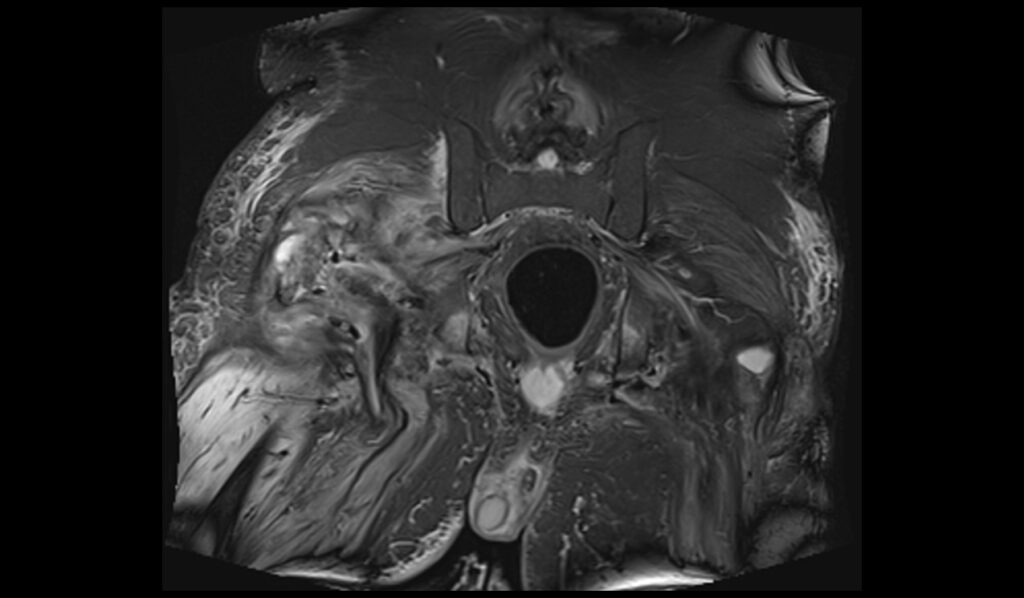 Pelvic ostiomelitis MRI | Radiology article on Pelvic osteomyelitis