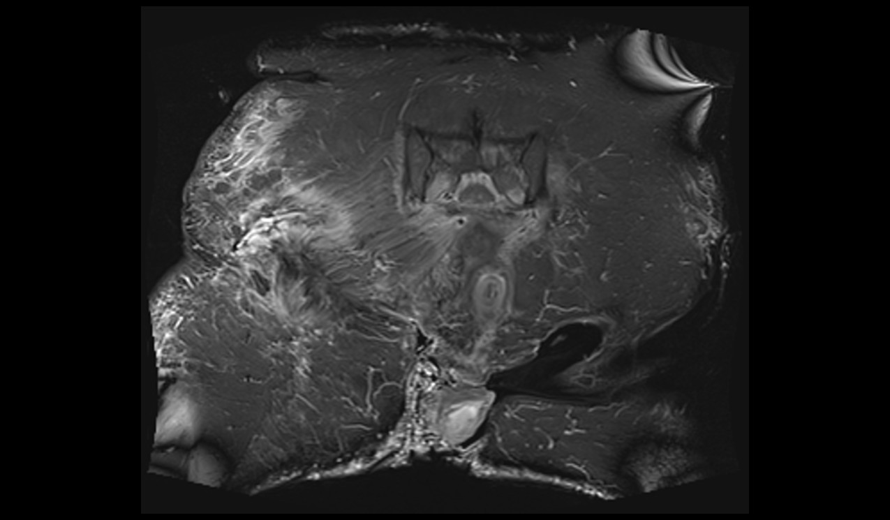 Pelvic ostiomelitis MRI | Radiology article on Pelvic osteomyelitis